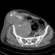 Tumour of cecum, gigantic, osteolysis of lumbar vertebra: CT - Computed tomography